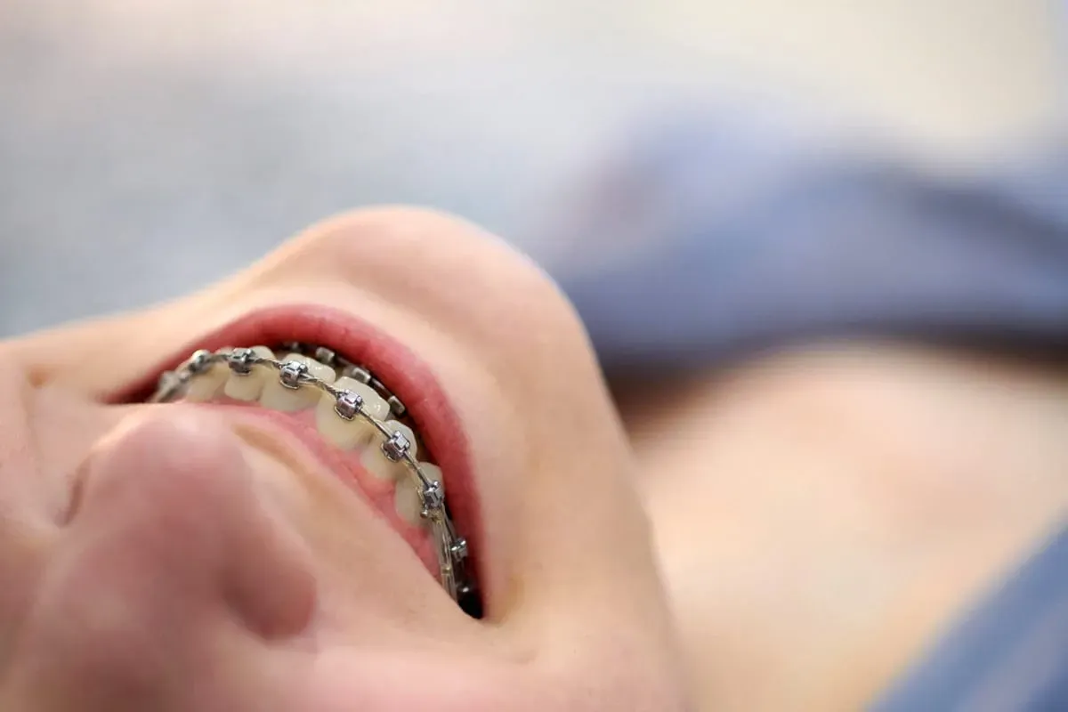 Traditional Braces: Process, Timeline & Care Guide