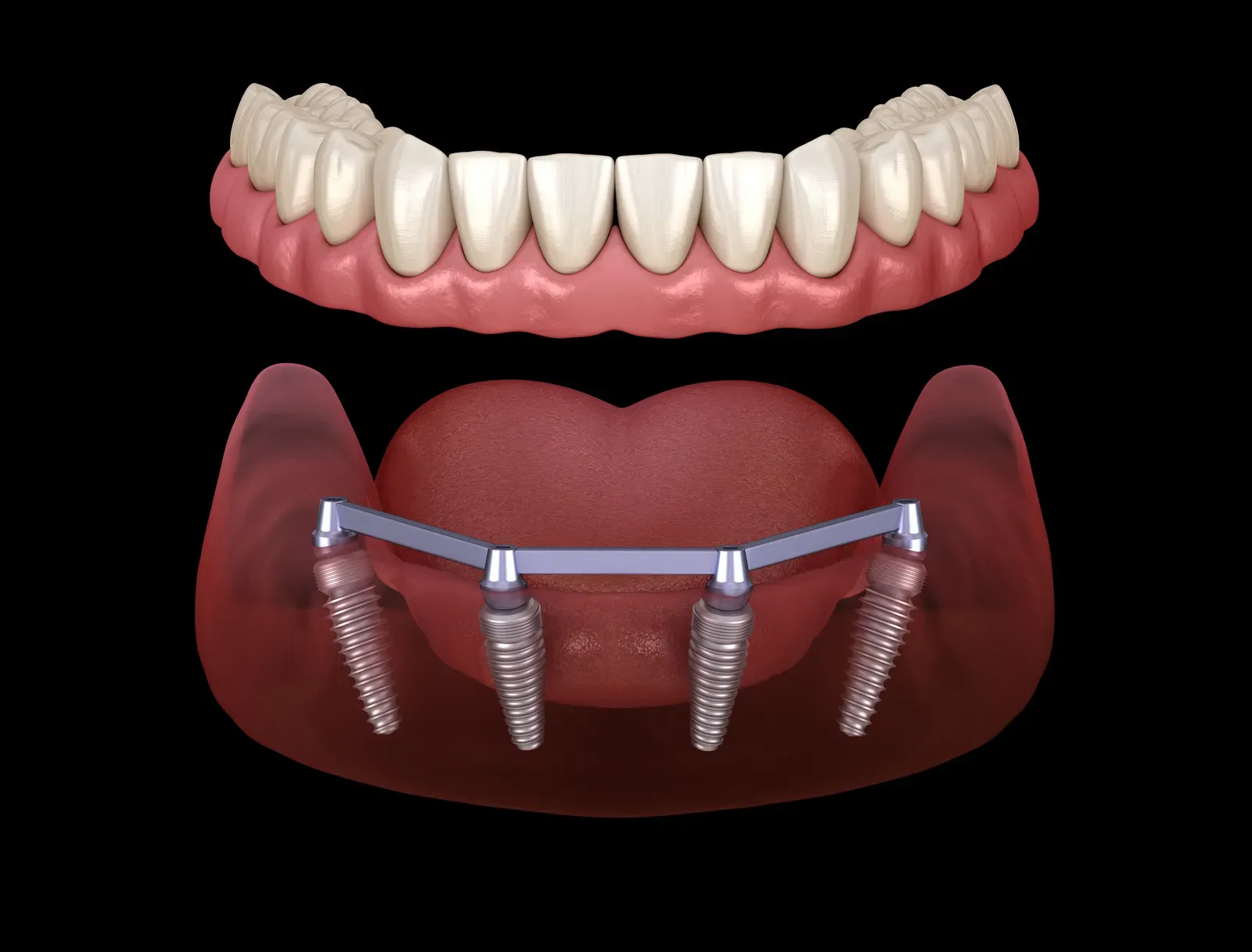 Dental Implants at Flossophy Dental Haltom